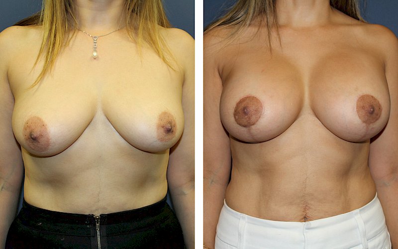 Breast Augmentation + Mastopexy Case Study at [[company]] - Before and After Photos