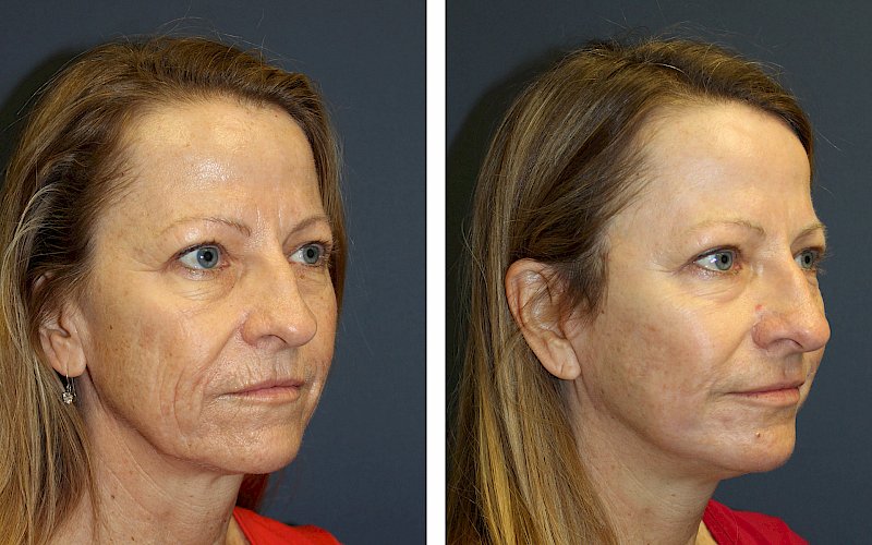 Mini Facelift + Laser Resurfacing  Center for Dermatology & Plastic Surgery