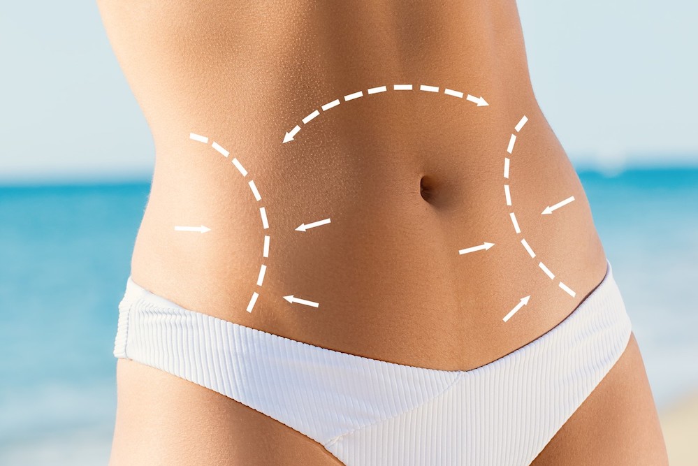 Saggy skin on the tummy: What can I do? - Hourglass Tummy Tuck