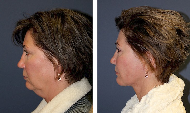 before and after chin augmentation