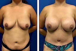 Breast Augmentation at [[company]] - Before and After