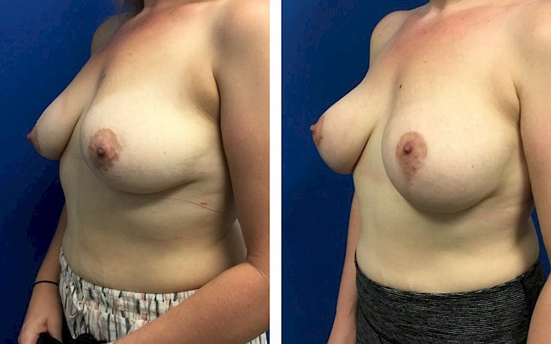 Breast Augmentation, Breast Lift Case Study at [[company]] - Before and After Photo