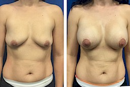 Breast Augmentation, Breast Lift Case Study at [[company]] - Before and After Photo